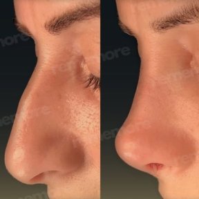 Before and after alarplasty results at Memorial Bahçelievler Hospital, nostril reshaping