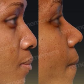 Before and after alarplasty results at Memorial Bahçelievler Hospital, refined nose shape