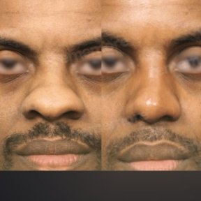 Before and after alarplasty results at Memorial Bahçelievler Hospital, nose reshaping