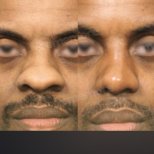 Before and after alarplasty results at Memorial Bahçelievler Hospital, nose reshaping