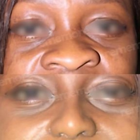 Before and after alarplasty results at Memorial Bahçelievler Hospital, nostril reshaping