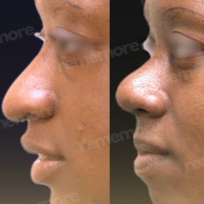 Before and after alarplasty results at Memorial Bahçelievler Hospital, nostril reshaping