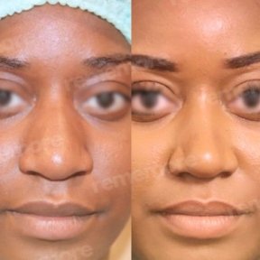 Before and after alarplasty results at Memorial Bahçelievler Hospital, refined nose shape