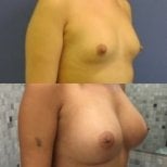 Before and after breast implants with lift results at Memorial Göztepe Hospital, enhanced shape