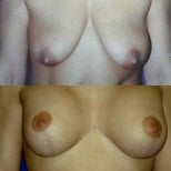 Before and after breast implants with lift at Memorial Göztepe Hospital, enhanced breast shape result