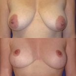 Before and after breast implants with lift at Memorial Göztepe Hospital, enhanced breast shape result