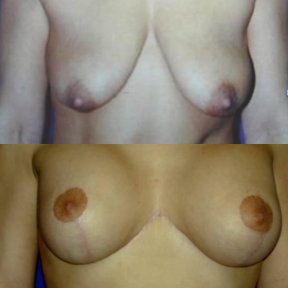 Before and after breast lift results at Memorial Ataşehir Hospital, improved breast contour