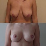 Before and after breast lift results at Memorial Ataşehir Hospital, improved breast contour