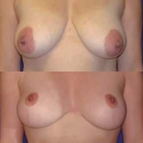 Before and after breast lift results at Memorial Ataşehir Hospital, improved breast contour