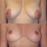 Before and after breast lift results at Memorial Ataşehir Hospital, improved breast contour