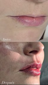before-after photo hyaluronic-acid-fillers