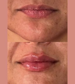 before-after photo hyaluronic-acid-fillers