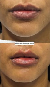 before-after photo hyaluronic-acid-fillers