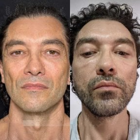 Before and after facial fat transfer results at Dr. Safa Manav Clinic, improved facial volume