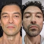 Before and after facial fat transfer results at Dr. Safa Manav Clinic, improved facial volume