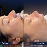 Before and after rhinoplasty results at Dr. Safa Manav Clinic, improved nose shape profile
