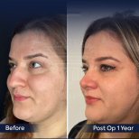 Before and after rhinoplasty result at Dr. Safa Manav Clinic, nose reshaping after 1 year