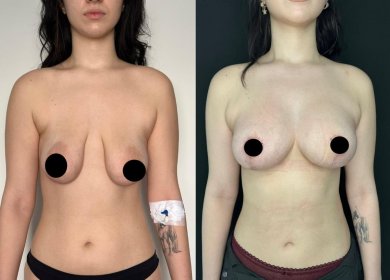 Before and after breast lift results at Dr. Safa Manav Clinic, improved breast shape and contour