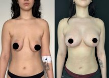 Before and after breast lift results at Dr. Safa Manav Clinic, improved breast shape and contour