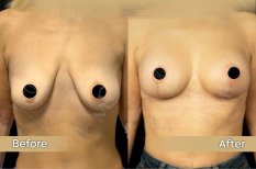 Before and after breast lift results at Dr. Safa Manav Clinic, improved breast contour