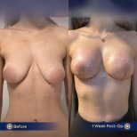 Before and after breast lift results at Dr. Safa Manav Clinic, visible lift and contour change