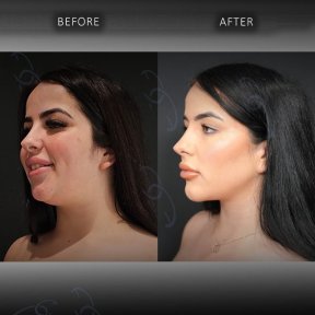 Before and after chin liposuction results at Dr. Safa Manav Clinic, improved jawline contour