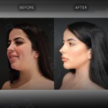Before and after chin liposuction results at Dr. Safa Manav Clinic, improved jawline contour