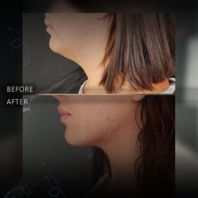 Before and after chin liposuction results at Dr. Safa Manav Clinic, improved jawline contour