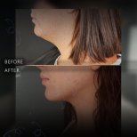 Before and after chin liposuction results at Dr. Safa Manav Clinic, improved jawline contour