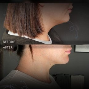 Before and after chin liposuction results at Dr. Safa Manav Clinic, improved jawline contour