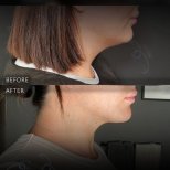 Before and after chin liposuction results at Dr. Safa Manav Clinic, improved jawline contour