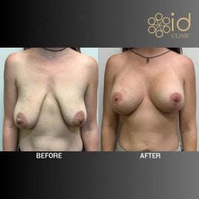 before-after photo breast-implants-with-breast-lift