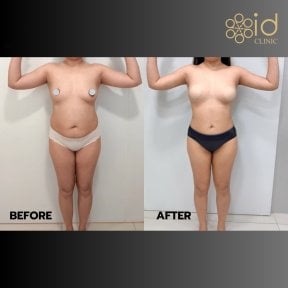 before-after photo 360-liposuction