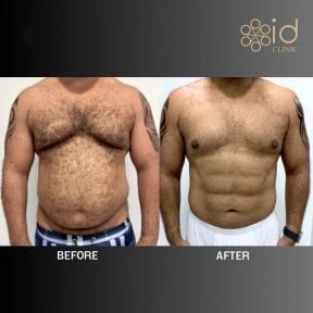 before-after photo gynecomastia-surgery