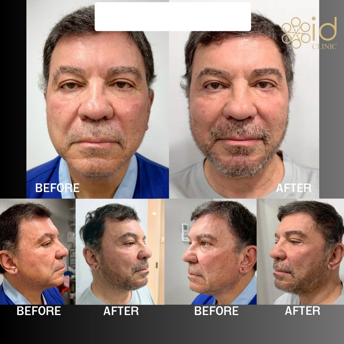 Resultados de trasplante de barba antes y después en ID Clinic Bangkok, barba más densa