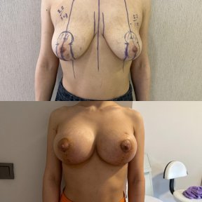 before-after photo breast-implant-revision