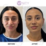نتائج عملية تجميل الأنف قبل وبعد في Vanity Cosmetic Surgery Hospital، تحسين شكل الأنف