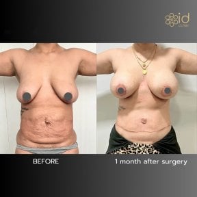 before-after photo abdominoplasty
