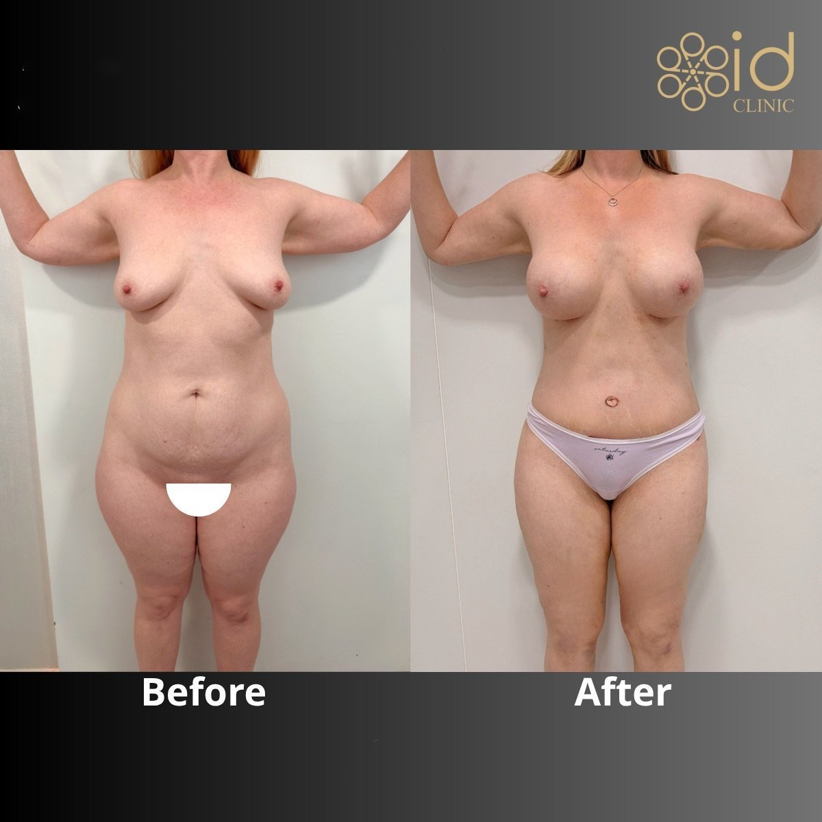 Resultados de abdominoplastia antes y después en ID Clinic Bangkok, mejora del contorno abdominal