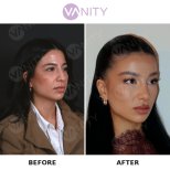 Resultados de rinoplastia antes y después en Vanity Cosmetic Surgery Hospital, nariz refinada