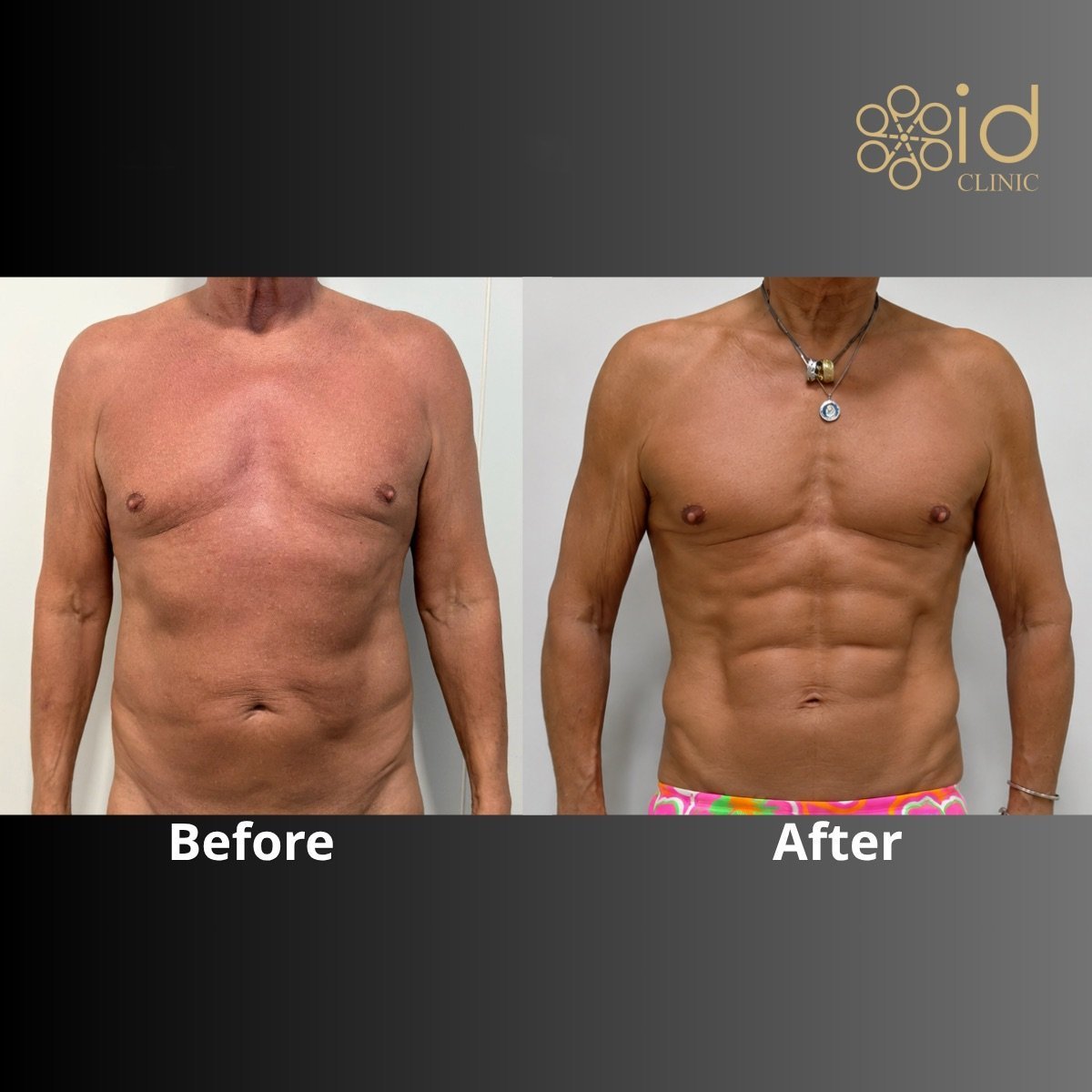 Resultados de liposucción 360 antes y después en ID Clinic Bangkok, contorno corporal masculino