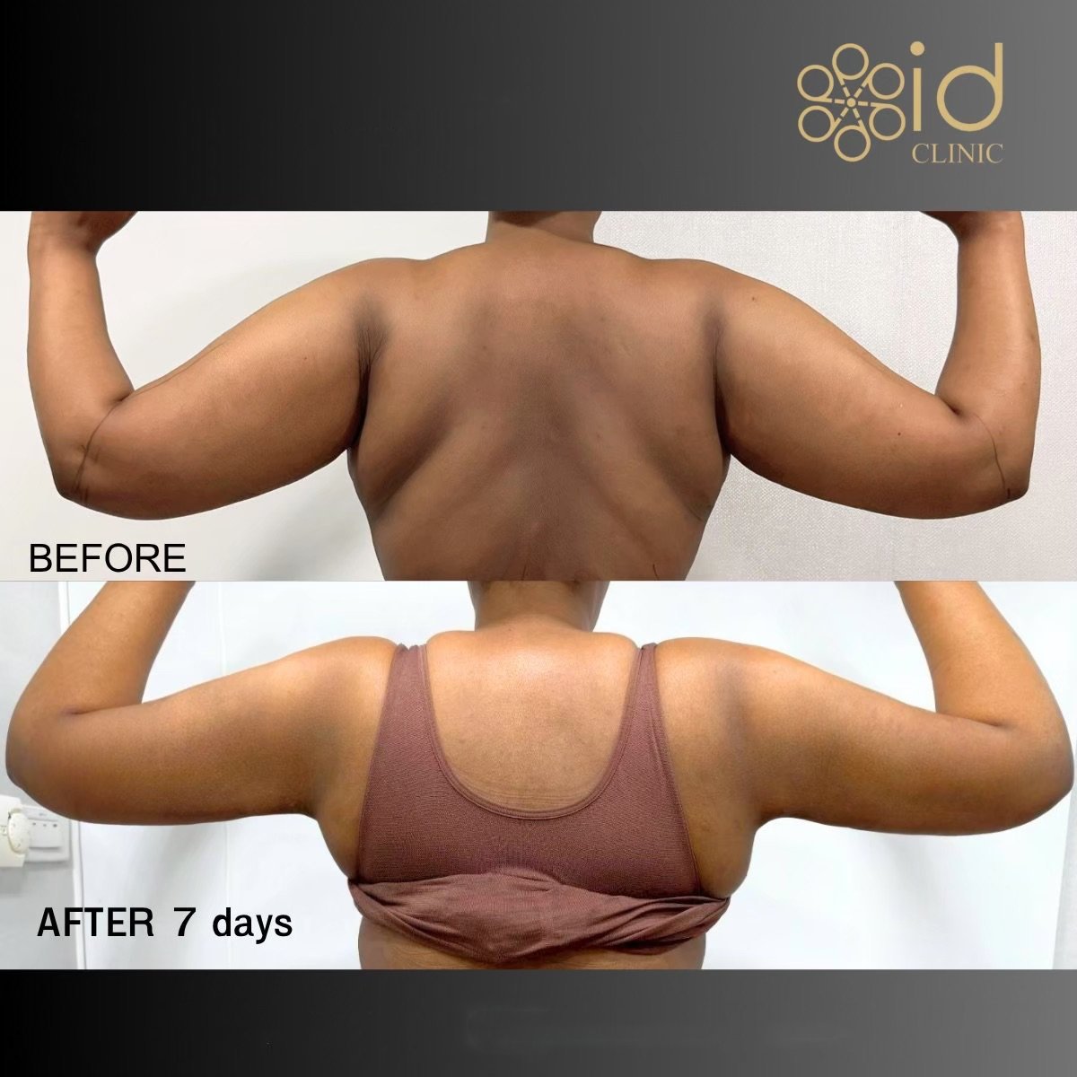 نتائج شد الذراعين (براكيوبلاستي) قبل وبعد في ID Clinic Bangkok، ذراعان أنحف