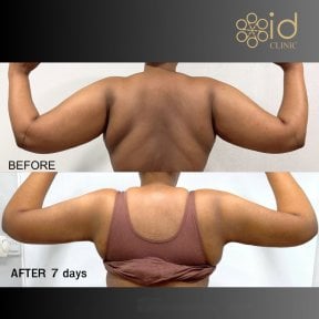 before-after photo arms-plastics-brachioplasty