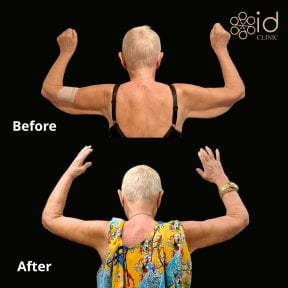 before-after photo arms-plastics-brachioplasty