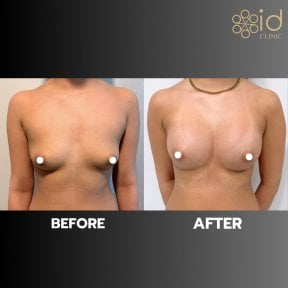 before-after photo breast-augmentation