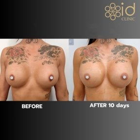 before-after photo breast-augmentation