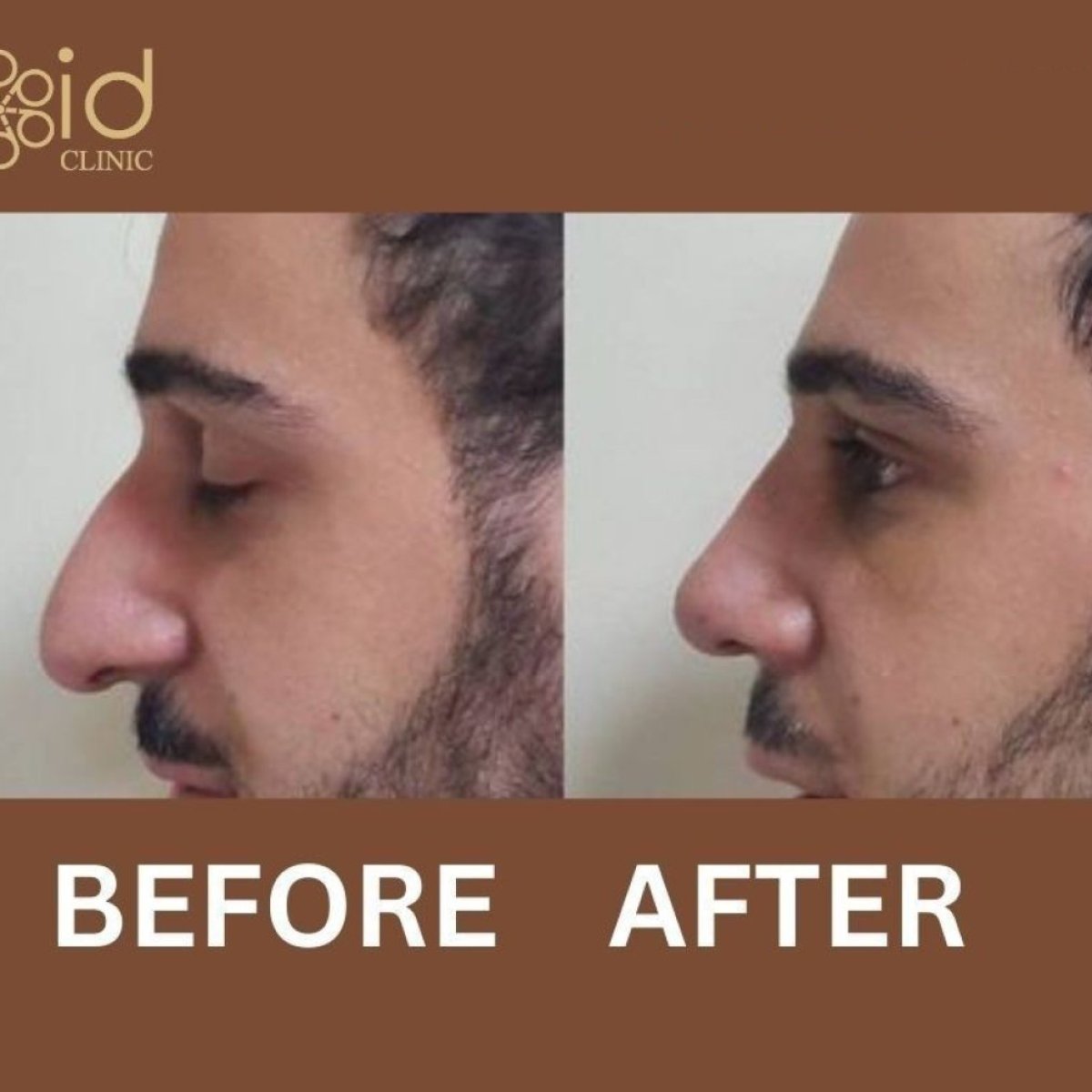 Resultados de rinoplastia antes y después en ID Clinic Bangkok, remodelación nasal masculina