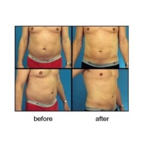 before-after photo liposuction