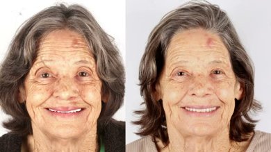 نتائج زراعة الأسنان قبل وبعد لسيدة مسنة – ابتسامة ومحاذاة أسنان محسنة