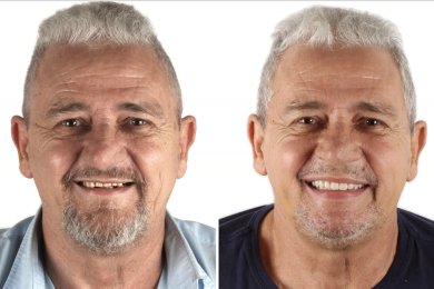 نتائج قبل وبعد زراعة الأسنان – ابتسامة محسنة واستعادة الأسنان